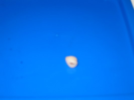 Tim's tooth (01-04-2010 17:04)