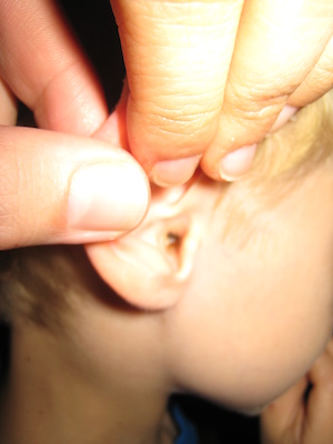 Cole's ear tubes coming out (06-16-2010 18:50)