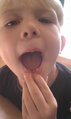 Cole's missing teeth (12-29-2010 12:55)