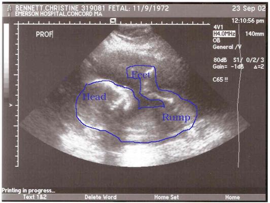 Baby Ultrasound 2 (annotated)