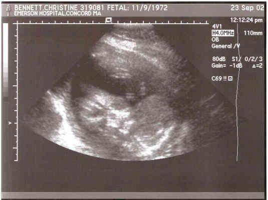 Baby Ultrasound 3