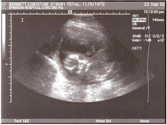 Baby Ultrasound 4