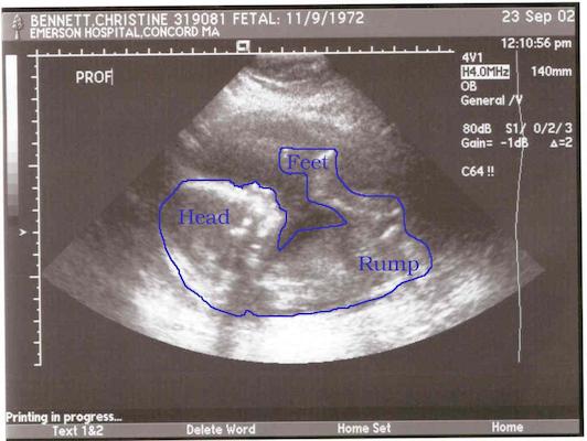 Baby Ultrasound 5 (annotated)