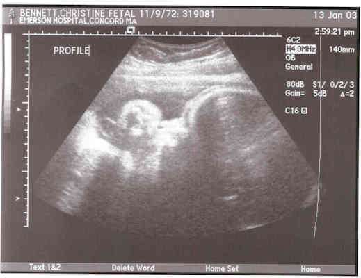 Ultrasound (profile with hand)