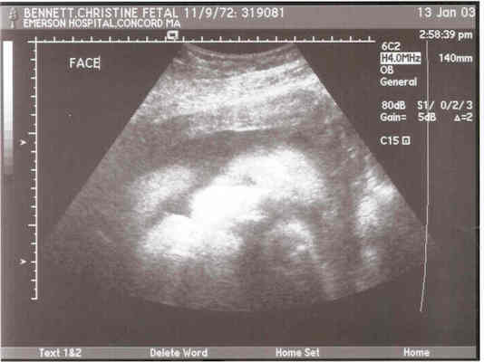 Ultrasound (full face)