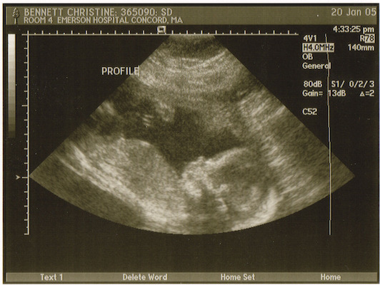 Ultrasound (01-20-2005 16:33)
