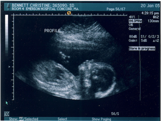 Ultrasound (01-20-2005 16:33)