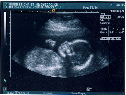Ultrasound (01-20-2005 16:33)